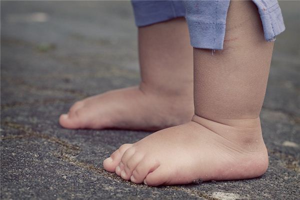 梦见脚肿是什么意思 梦见脚肿是什么意思