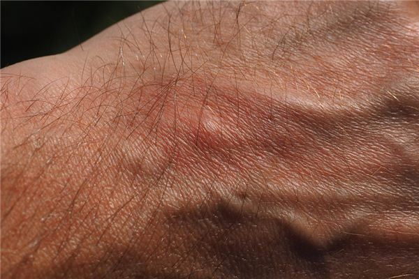 梦见脓疱是什么意思 梦见脓疱是什么意思