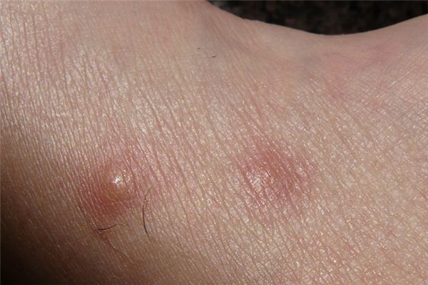 梦见过敏是什么意思 梦见过敏是什么意思