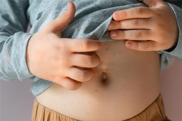 梦见疥疮是什么意思 梦见疥疮是什么意思